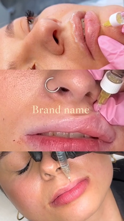 Relleno de labios