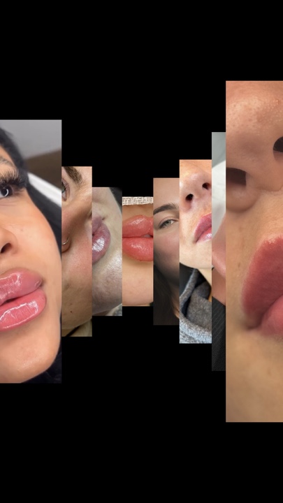 Relleno de labios