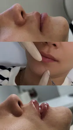 Preenchimento Labial