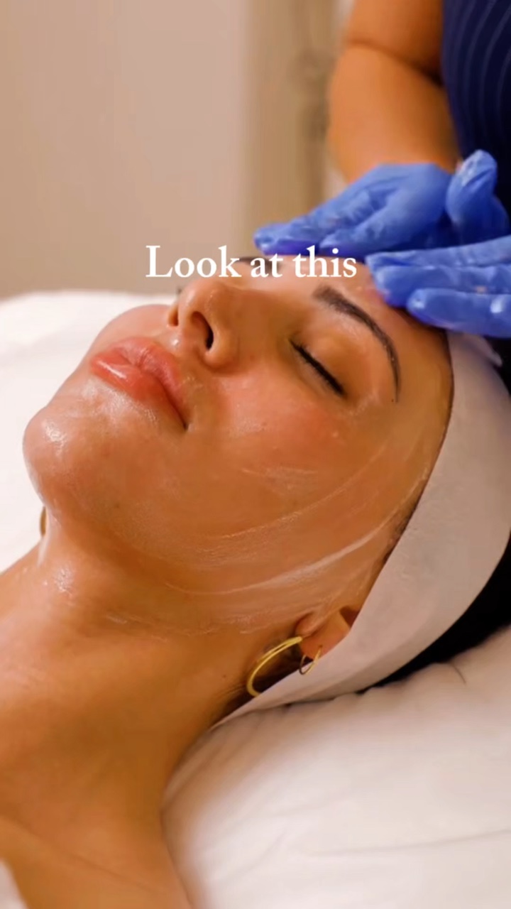 Microneedling 