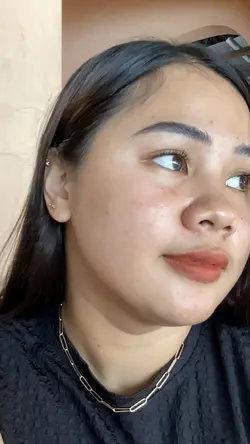 Acne Journey