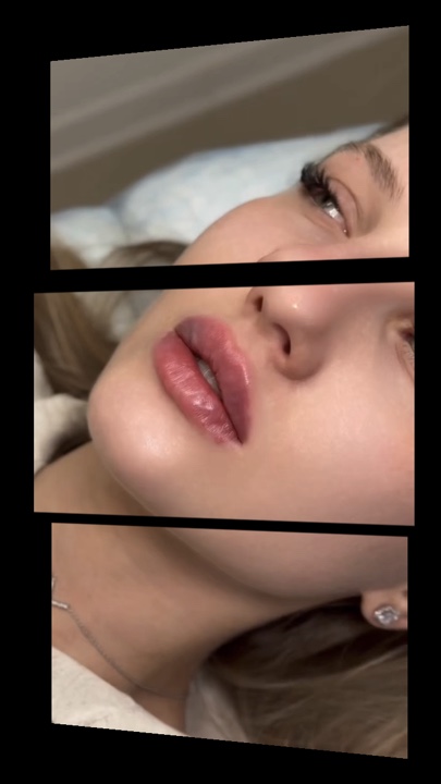 Lip filler