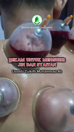 Bekam Sunnah Idn