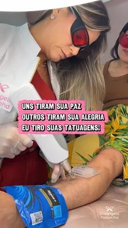 Remoção tatuagem