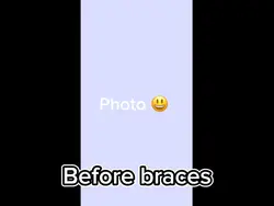 I got braces edit